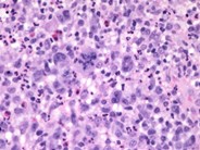 Anaplastic Large Cell Lymphoma 11
