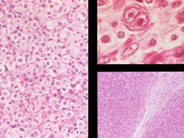 Anaplastic Large Cell Lymphoma - 6.