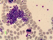 platelet-clump-in-peripheral-blood-smear