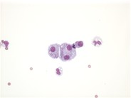 Neuroblastoma - pleural fluid - 4.