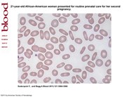 Hereditary elliptocytosis
