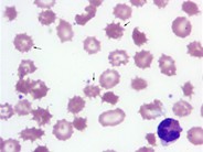 Purpura fulminans in an adult