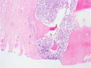 Paraneoplastic hypercalcemia in Diffuse Large B-Cell NHL - 10.