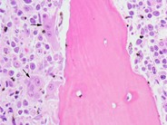 Paraneoplastic hypercalcemia in Diffuse Large B-Cell NHL - 11.