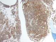 Paraneoplastic hypercalcemia in Diffuse Large B-Cell NHL - 9.