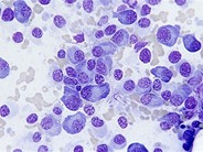 Multiple Myeloma - 1.