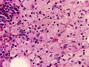 Gaucher's Disease 1(c).