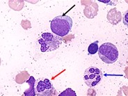 Acute myeloid leukemia with multilineage dysplasia - 1.