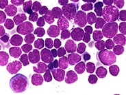 Precusor B-cell Acute Lymphoblastic Leukemia - 4.