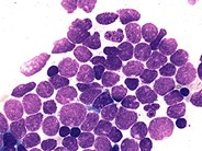 Precusor B-cell Acute Lymphoblastic Leukemia - 5.