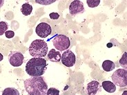 Acute Myeloid Leukemia with inv 16 - 5.