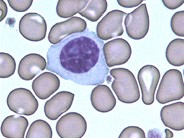 Atypical Lymphocyte - 1.