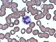 Hypersegmented Neutrophil - 1.