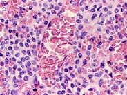 Hairy Cell Leukemia - 10.