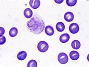 Hairy Cell Leukemia - 11.