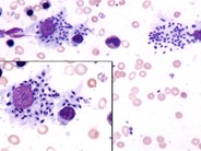 Bone marrow leishmaniasis