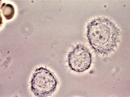 Hairy Cell Leukemia - 7.