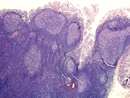 Mantle Cell Lymphoma - 11.