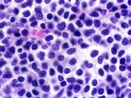 Mantle Cell Lymphoma - 6.