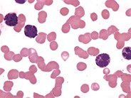 Acute Basophilic Leukemia - 2.