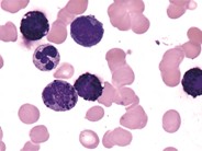 Acute Basophilic Leukemia - 3.