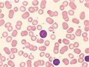 Sezary syndrome - peripheral blood