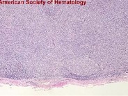 Angioimmunoblastic T Cell Lymphoma - 2.