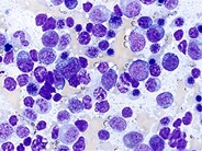 Angioimmunoblastic T Cell Lymphoma - 8.