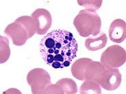 Apoptotic Granulocyte - 1.