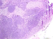 Diffuse Large B-cell Lymphoma, Anaplastic Variant - 4.