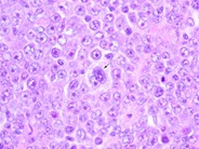 Diffuse Large B-cell Lymphoma, Anaplastic Variant - 3.