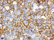 Diffuse Large B-cell Lymphoma, Anaplastic Variant - 4.