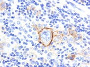 Diffuse Large B-cell Lymphoma, Anaplastic Variant - 6.