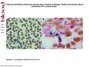 Sideroblastic anemia secondary to zinc toxicity