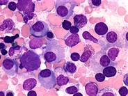 Multiple Myeloma - 3.