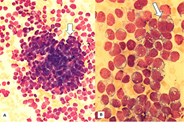 Diagnosis of Neuroblastoma by Bone Marrow Aspiration