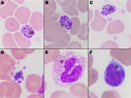 Plasmodium falciparum – schizonts, merozoites and haemozoin