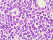 Burkitt Leukemia