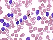 Chronic Lymphocytic Leukemia - 3.