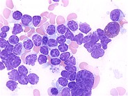 Chronic Lymphocytic Leukemia - 5.