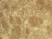 Follicular Lymphoma - 10.