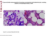 Pure white cell aplasia in a patient with thymic carcinoma