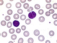 Pertussis - 1.