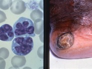 Adult T-cell Leukemia - 1.