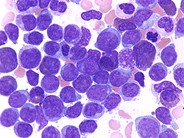 AML With Maturation - 5.
