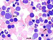 Relapsed Precursor B Cell Acute Lymphoblastic Leukemia - 2.