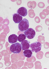 Adult T-cell Leukemia/Lymphoma - 1.