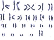 Adult T-cell Leukemia/Lymphoma - 2.