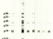 Adult T-cell Leukemia/Lymphoma - 4.