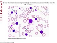 BSS misdiagnosed as ITP